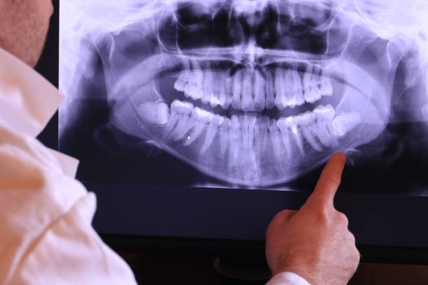 Emergency Dental Filling Replacement in ID